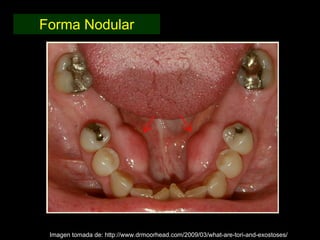 Forma Nodular




 Imagen tomada de: http://www.drmoorhead.com/2009/03/what-are-tori-and-exostoses/
 