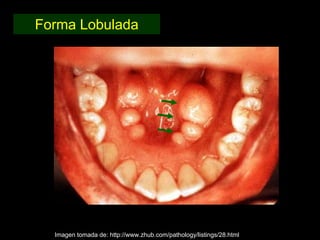 Forma Lobulada




  Imagen tomada de: http://www.zhub.com/pathology/listings/28.html
 