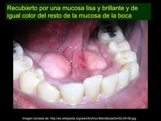 Recubierto por una mucosa lisa y brillante y de
igual color del resto de la mucosa de la boca




     Imagen tomada de: http://es.wikipedia.org/wiki/Archivo:Mandibulartori02-04-06.jpg
 