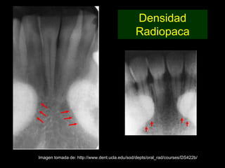 Densidad
                                               Radiopaca




Imagen tomada de: http://www.dent.ucla.edu/sod/depts/oral_rad/courses/DS422b/
 
