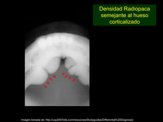 Densidad Radiopaca
                                                            semejante al hueso
                                                               corticalizado




Imagen tomada de: http://uop2007dds.com/resources/Studyguides/Differential%20Diagnosis/
 