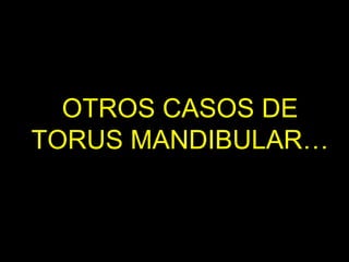 OTROS CASOS DE
TORUS MANDIBULAR…
 