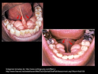 Imágenes tomadas de: http://www.writingcures.com/files/ y
http://www.free-ed.net/sweethaven/MedTech/Dental/OralPath/lessonmain.asp?iNum=fra0159
 