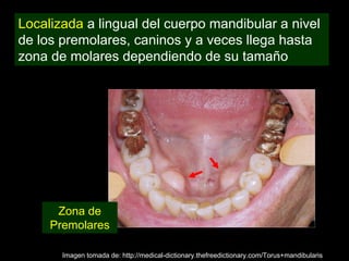 Localizada a lingual del cuerpo mandibular a nivel
de los premolares, caninos y a veces llega hasta
zona de molares dependiendo de su tamaño




      Zona de
     Premolares

       Imagen tomada de: http://medical-dictionary.thefreedictionary.com/Torus+mandibularis
 