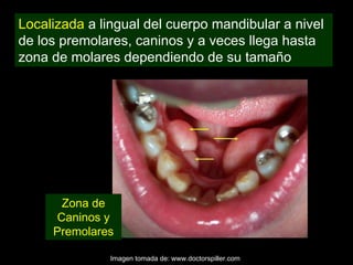 Localizada a lingual del cuerpo mandibular a nivel
de los premolares, caninos y a veces llega hasta
zona de molares dependiendo de su tamaño




       Zona de
      Caninos y
     Premolares

               Imagen tomada de: www.doctorspiller.com
 