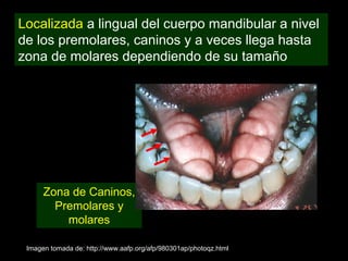 Localizada a lingual del cuerpo mandibular a nivel
de los premolares, caninos y a veces llega hasta
zona de molares dependiendo de su tamaño




      Zona de Caninos,
        Premolares y
          molares

 Imagen tomada de: http://www.aafp.org/afp/980301ap/photoqz.html
 
