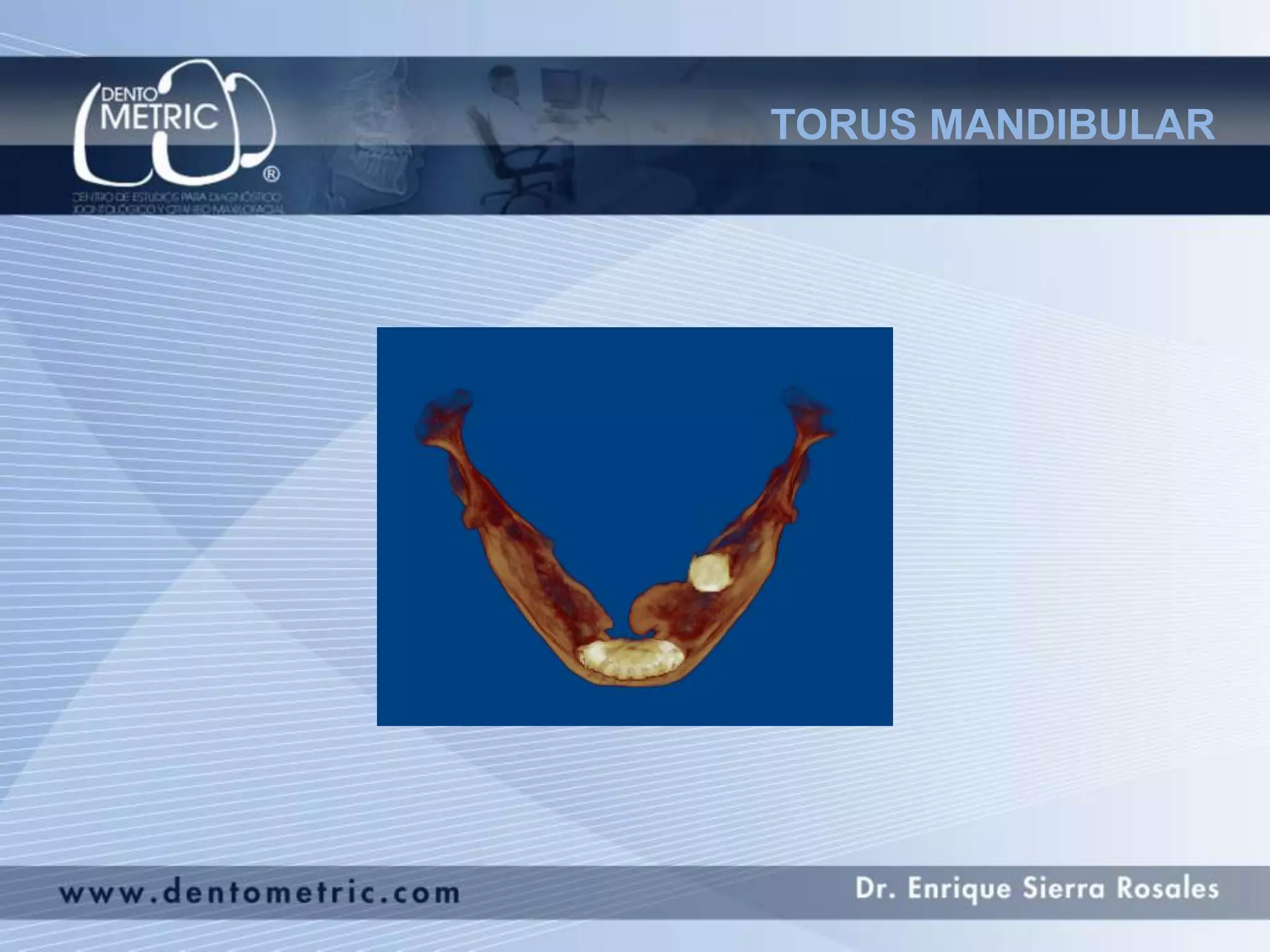 Torus Mandibular | PPT