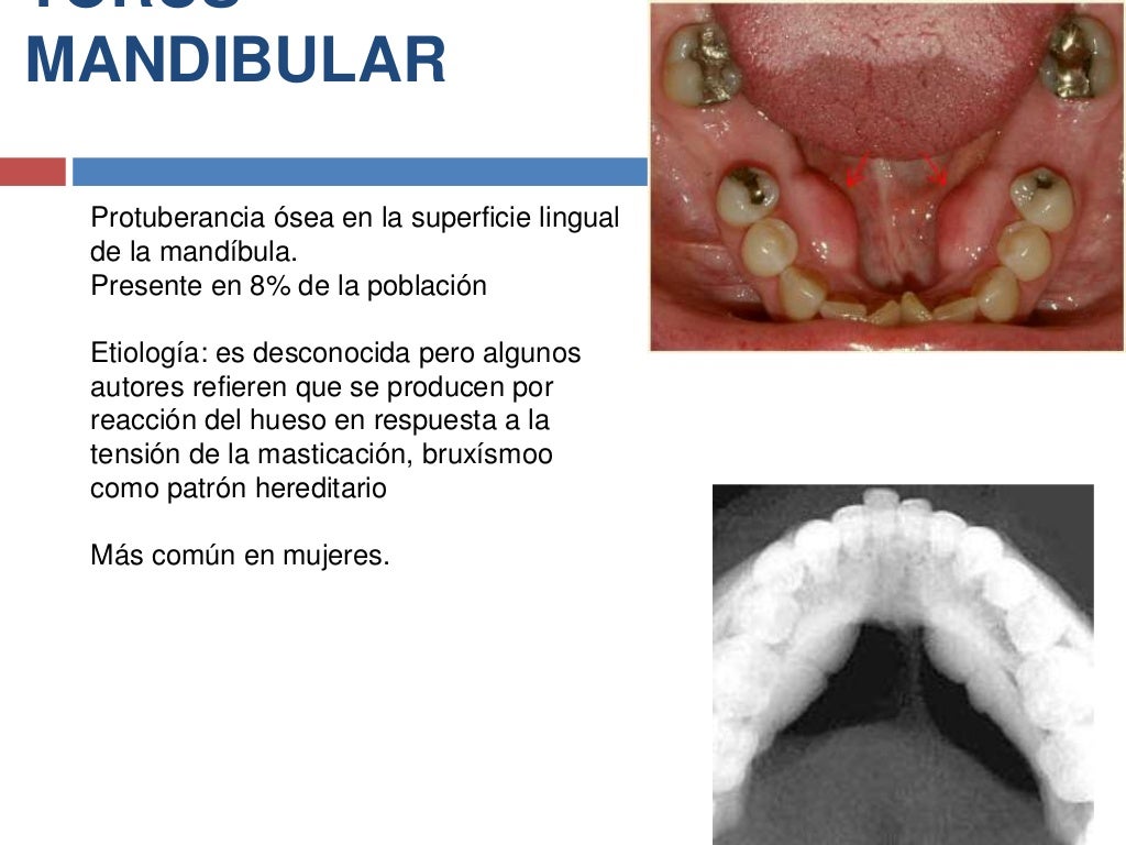 Torus palatino y mandibular