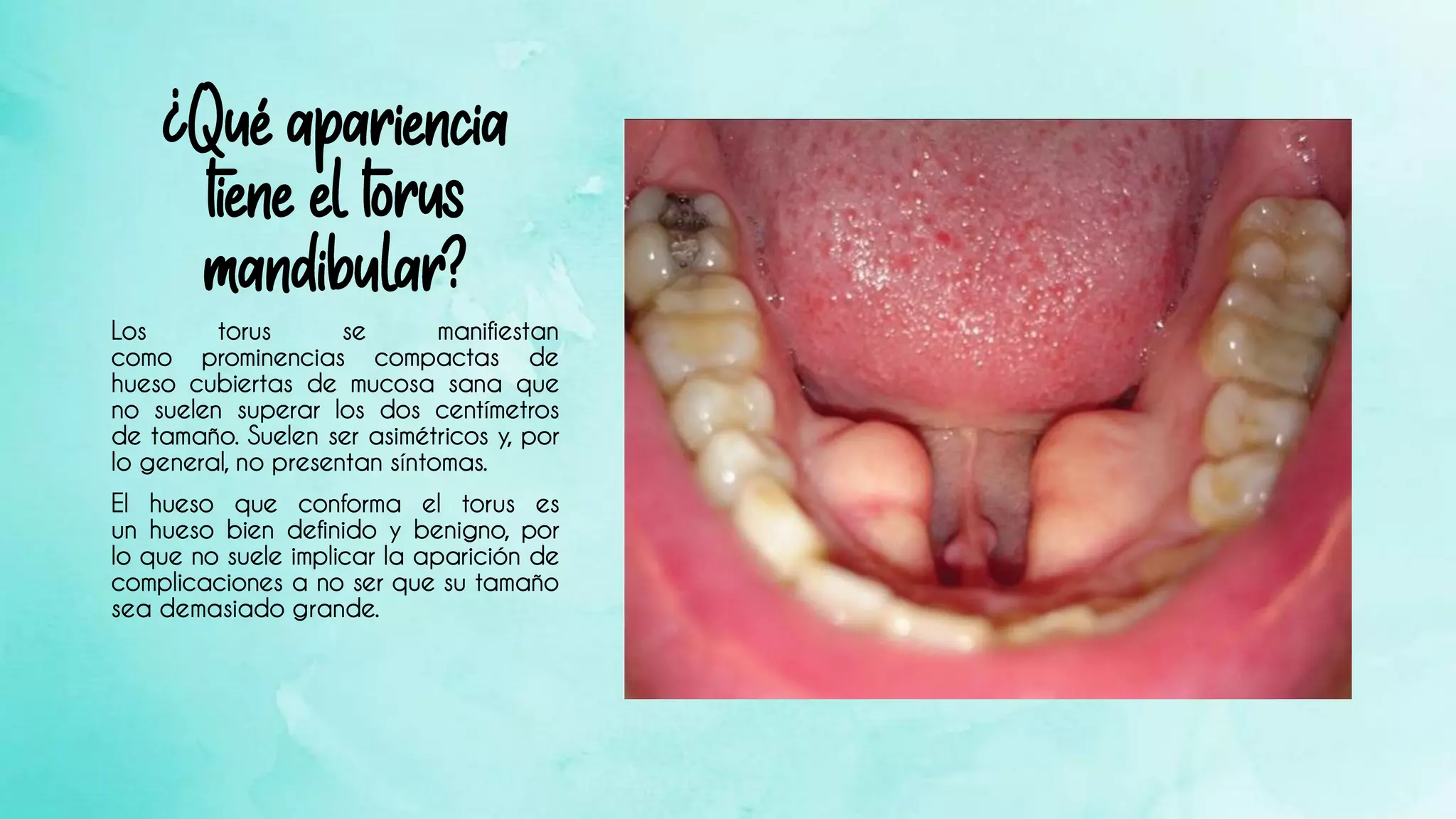Torus palatino y mandibular | PDF