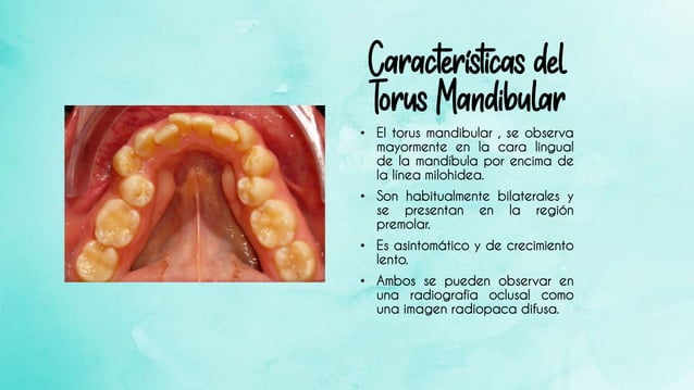 Torus palatino y mandibular | PDF