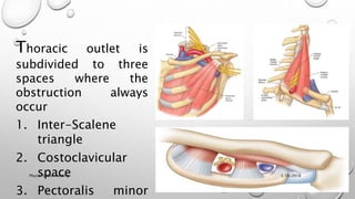 Thoracic outlet is
subdivided to three
spaces where the
obstruction always
occur
1. Inter-Scalene
triangle
2. Costoclavicular
space
3. Pectoralis minor
3/18/2018Physio-Ortho meeting
 