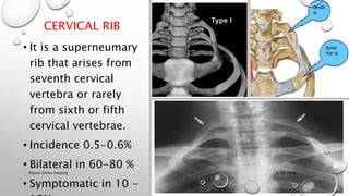 CERVICAL RIB
• It is a superneumary
rib that arises from
seventh cervical
vertebra or rarely
from sixth or fifth
cervical vertebrae.
• Incidence 0.5-0.6%
• Bilateral in 60-80 %
• Symptomatic in 10 -
3/18/2018Physio-Ortho meeting
 