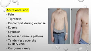 Acute occlusion
• Pain
• Tightness
• Discomfort during exercise
• Edema
• Cyanosis
• Increased venous pattern
• Tenderness over the
axillary vein
• Gangrene rarely
3/18/2018
 