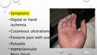 •Symptoms
•Digital or hand
ischemia
•Cutaneous ulcerations
•Forearm pain with use
•Pulsatile
supraclavicular 3/18/2018Physio-Ortho meeting
 