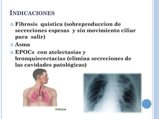 INDICACIONES
 Fibrosis quistica (sobreproduccion de
secreciones espesas y sin movimiento ciliar
para salir)
 Asma
 EPOCs con atelectasias y
bronquiecectacias (elimina secreciones de
las cavidades patológicas)
 