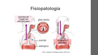 Fisiopatologia
CENTRO DE
TOSSE NO
HIPOTÁLAMO
NERVOVAGO
AUMENTA A
PRESSÃO
Fonte : Anatomia e Fisiologia humana. VILELA, M.
 