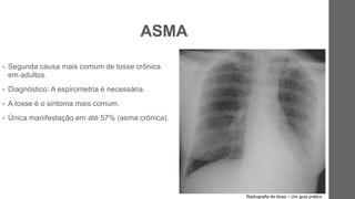ASMA
• Segunda causa mais comum de tosse crônica
em adultos.
• Diagnóstico: A espirometria é necessária.
• A tosse é o sintoma mais comum.
• Única manifestação em até 57% (asma crônica).
Radiografia de tórax – Um guia prático
 