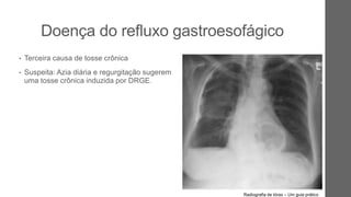 Doença do refluxo gastroesofágico
• Terceira causa de tosse crônica
• Suspeita: Azia diária e regurgitação sugerem
uma tosse crônica induzida por DRGE.
Radiografia de tórax – Um guia prático
ESOFÁGICA-BRÔNQUICA
ESÔFAGO DISTAL
REFLUXO ÁCIDO
Radiografia de tórax – Um guia prático
 