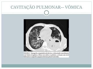 CAVITAÇÃO PULMONAR-- VÔMICA
 