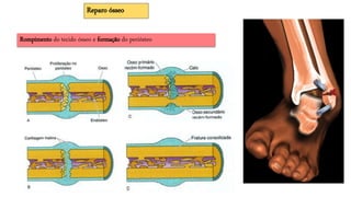 Rompimento do tecido ósseo e formação do periósteo
Reparo ósseo
 