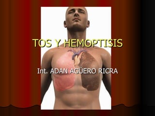 TOS Y HEMOPTISIS Int. ADAN AGÜERO RICRA 