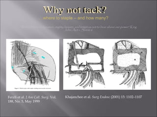 Ferzli et al.  J Am Coll. Surg.  Vol. 188, No. 5, May 1999 "Withold thine indignation, mighty heaven, and tempt us not to bear above our power” King John, Act v, Scene 6 … where to staple – and how many? Why not tack? Khajanchee et al.  Surg Endosc  (2001) 15: 1102–1107 