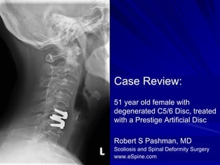 Case Review:
51 year old female with
degenerated C5/6 Disc, treated
with a Prestige Artificial Disc

Robert S Pashman, MD
Scoliosis and Spinal Deformity Surgery
www.eSpine.com
 