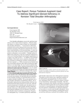Volume 3 – 2009 submitted for publication and consented. Case Report A 61-year-old right hand dominant male was referred to our shoulder clinic with debilitating right  shoulder pain of several years duration. He had three previous operations for this shoulder including an initial Putti-Platt procedure to address shoulder instability. The second operation was a total shoulder arthroplasty for debilitating arthritis. The to- tal shoulder replacement provided good pain relief but very limited functional improvement for several years. With the recurrent progression of shoulder pain, the patient had sev- eral evaluations of his right shoulder and had a diagnostic shoulder arthroscopy with debridement revealing a grossly loose glenoid component. He was referred to our tertiary care shoulder clinic for definitive management. Preopera- tive radiographs (Fig. 1) revealed a posteriorly subluxated Indiana Orthopaedic Journal Case Report: Porous Tantalum Augment Used To Address Significant Glenoid Deficiency in Revision Total Shoulder Arthroplasty Vivek Agrawal, M.D. The Shoulder Center – Zionsville, Indiana, USA Correspondence: Vivek Agrawal, MD The Shoulder Center 10801 N. Michigan Road, Suite 100 Zionsville, IN 46077 [email_address] Total  shoulder  arthroplasty   can provide significant pain relief as well as improvement in function. 1  Glenoid compo- nent failure is a common mode of failure for unconstrained total shoulder arthroplasty. 2,3  Fixed posterior subluxation combined with excessive glenoid retroversion may result in premature loosening of the glenoid component due to asym- metric load distribution in the horizontal plane. 4  A clear con- sensus on the results of corrective measures to address fixed posterior subluxation is not available. 5-7  Multiple options to address bony deficiency at the time of glenoid component re- vision exist including allograft and autograft augmentation in a single or two stage revision. 2,8-11  In addition to the potential morbidity of these graft sources, nonunion, dissolution, and loss of fixation as mechanisms of failure of both grafts has also been reported  5,12-14 . While structural porous tantalum has been successfully utilized in other adult reconstruction appli- cations, to our knowledge, the use of a porous tantalum aug- ment to successfully address significant glenoid bone loss has not been previously reported. 15  We present a case of a failed glenoid component presenting with significant glenoid bone loss and fixed posterior subluxation managed with a porous tantalum augment at the time of revision arthroplasty. The patient was informed that data concerning his case would be Figure 1a and 1b Preoperative images (Axillary and CT scan) show posterior sub- luxation with significant asymmetrical posterior glenoid wear and failed glenoid component total  shoulder replacement with a failed glenoid component. The patient was also noted to have significant weakness of his subscapularis and supraspinatus on clinical examina- tion. Subsequent EMG/NCV confirmed evidence of chronic severe demyelinative suprascapular neuropathy. After thor- oughly reviewing the risks, benefits, and options of treatment, we discussed with the patient that revision options included conversion to a hemiarthroplasty with grafting and resurfac- ing of his glenoid, reimplantation of a glenoid component, or conversion to a reverse total shoulder arthroplasty. Given the constellation of clinical findings, including both soft tis- sue and bony deficiency combined with instability, and the 38 