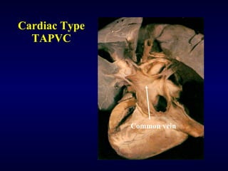 Cardiac Type TAPVC Common vein 