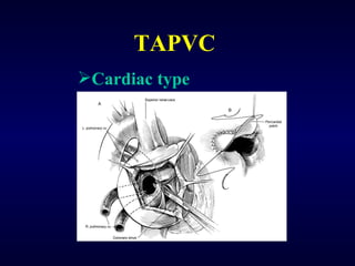 TAPVC Cardiac type 