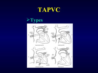 TAPVC Types 