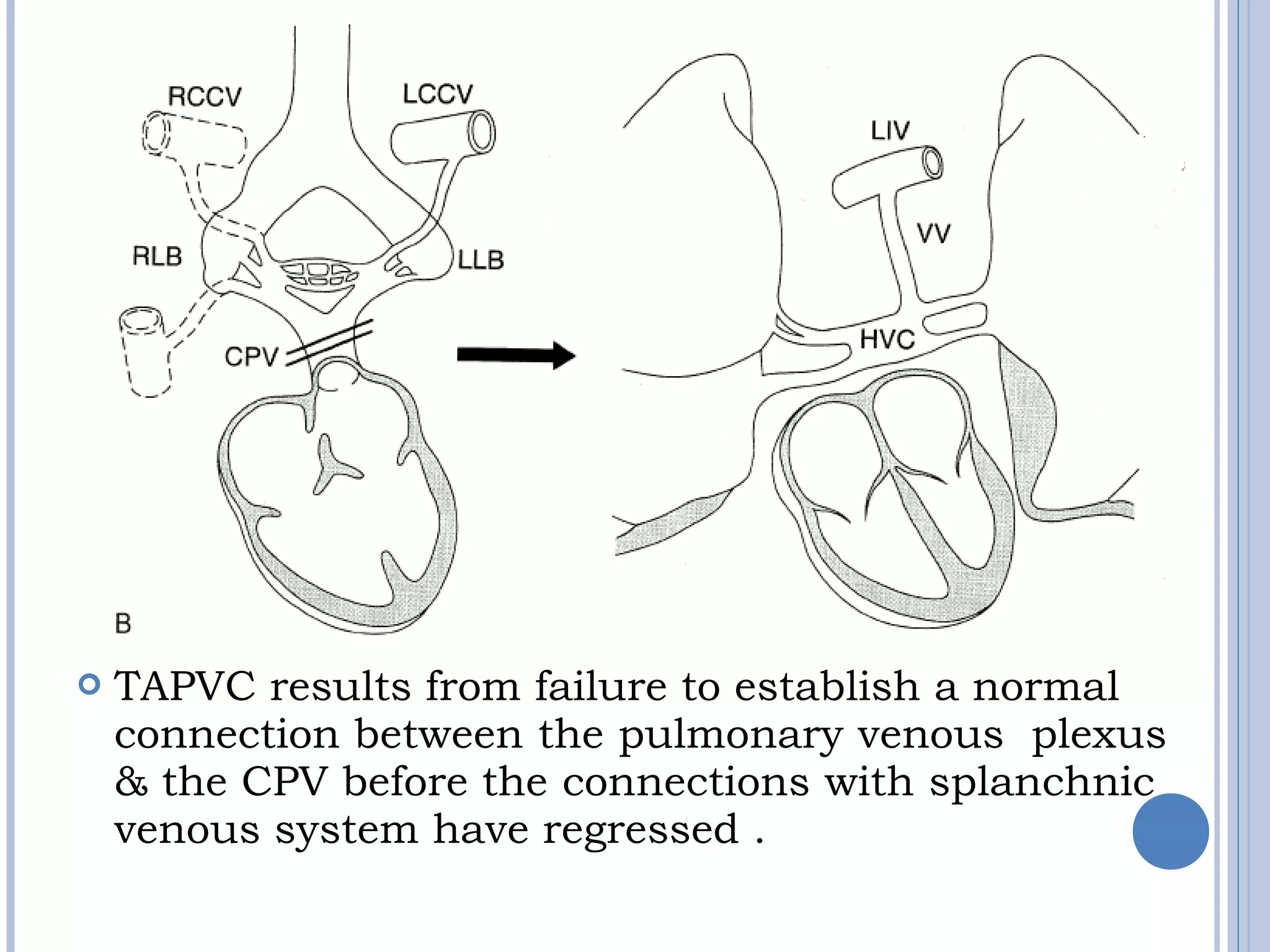  TAPVC results from failure to establish a normal
connection between the pulmonary venous plexus
& the CPV before the connections with splanchnic
venous system have regressed .
 