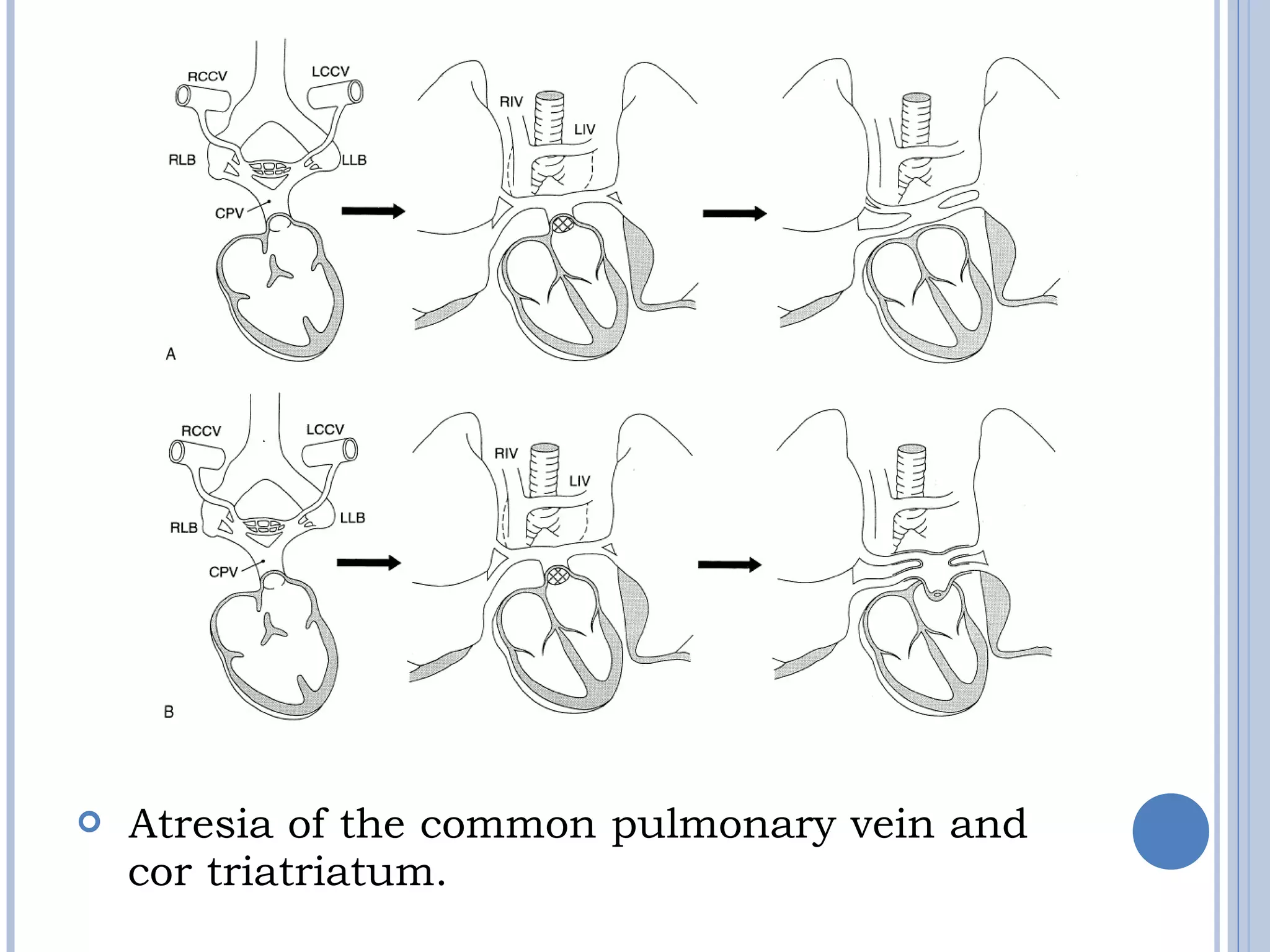   Atresia of the common pulmonary vein and 
cor triatriatum.
 