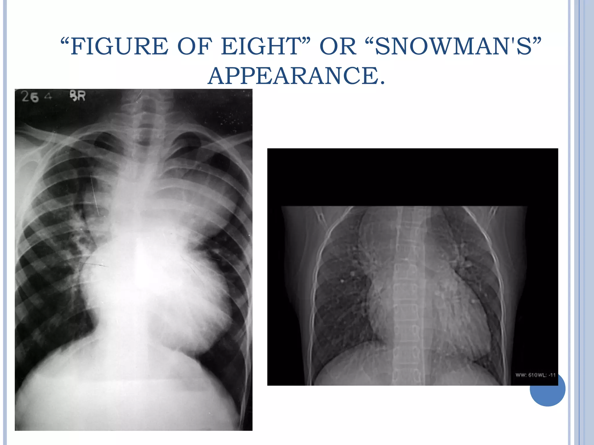  “FIGURE OF EIGHT” OR “SNOWMAN'S”
APPEARANCE.
 