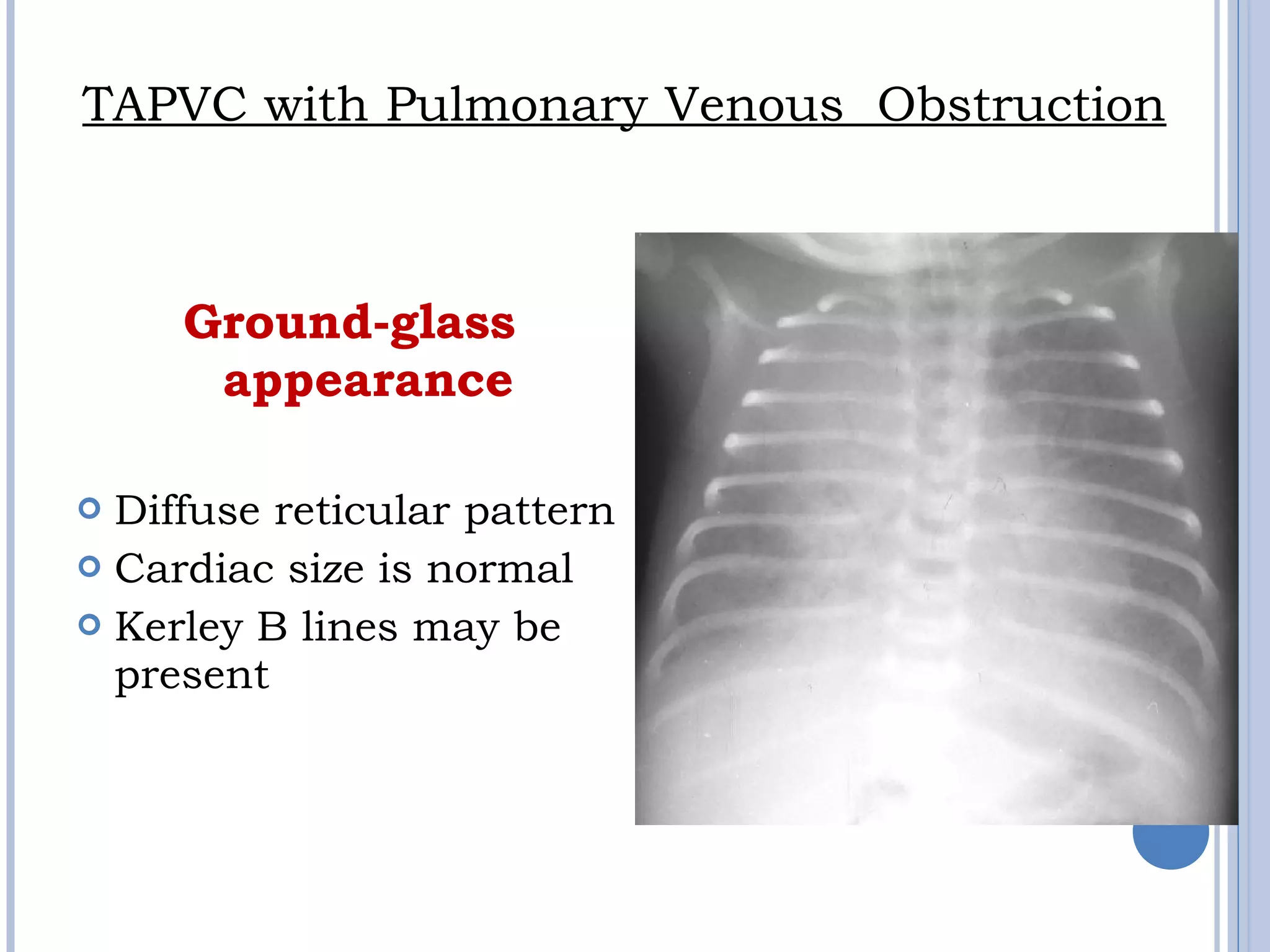Ground-glass
appearance
 Diffuse reticular pattern
 Cardiac size is normal
 Kerley B lines may be
present
TAPVC with Pulmonary Venous  Obstruction
 