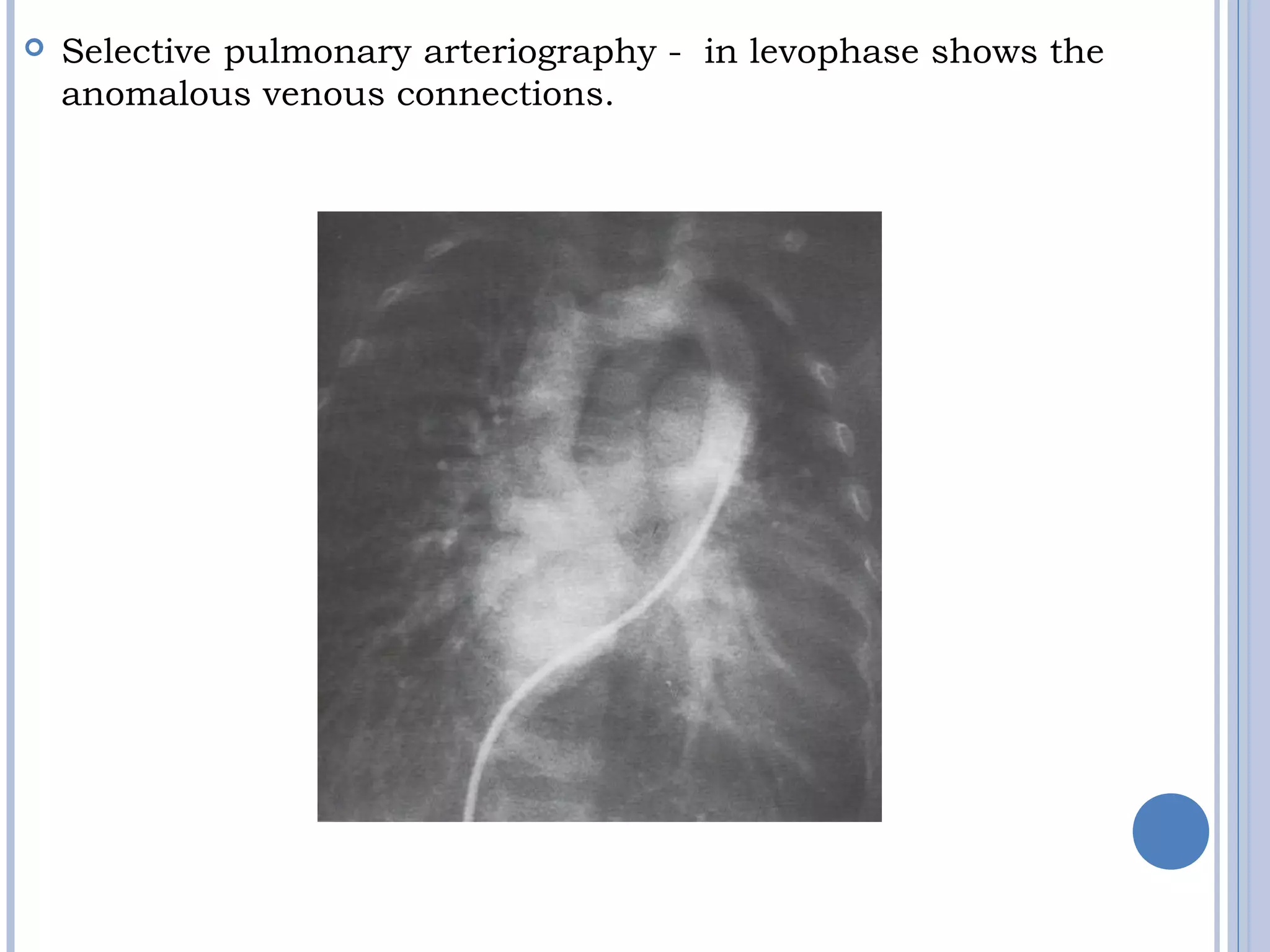  Selective pulmonary arteriography - in levophase shows the
anomalous venous connections.
 