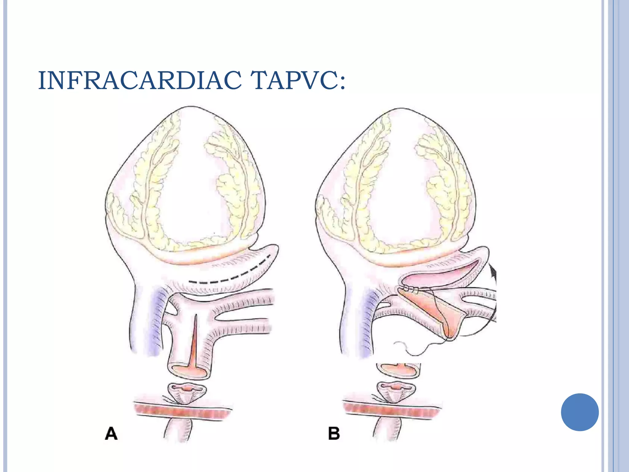 INFRACARDIAC TAPVC:
 