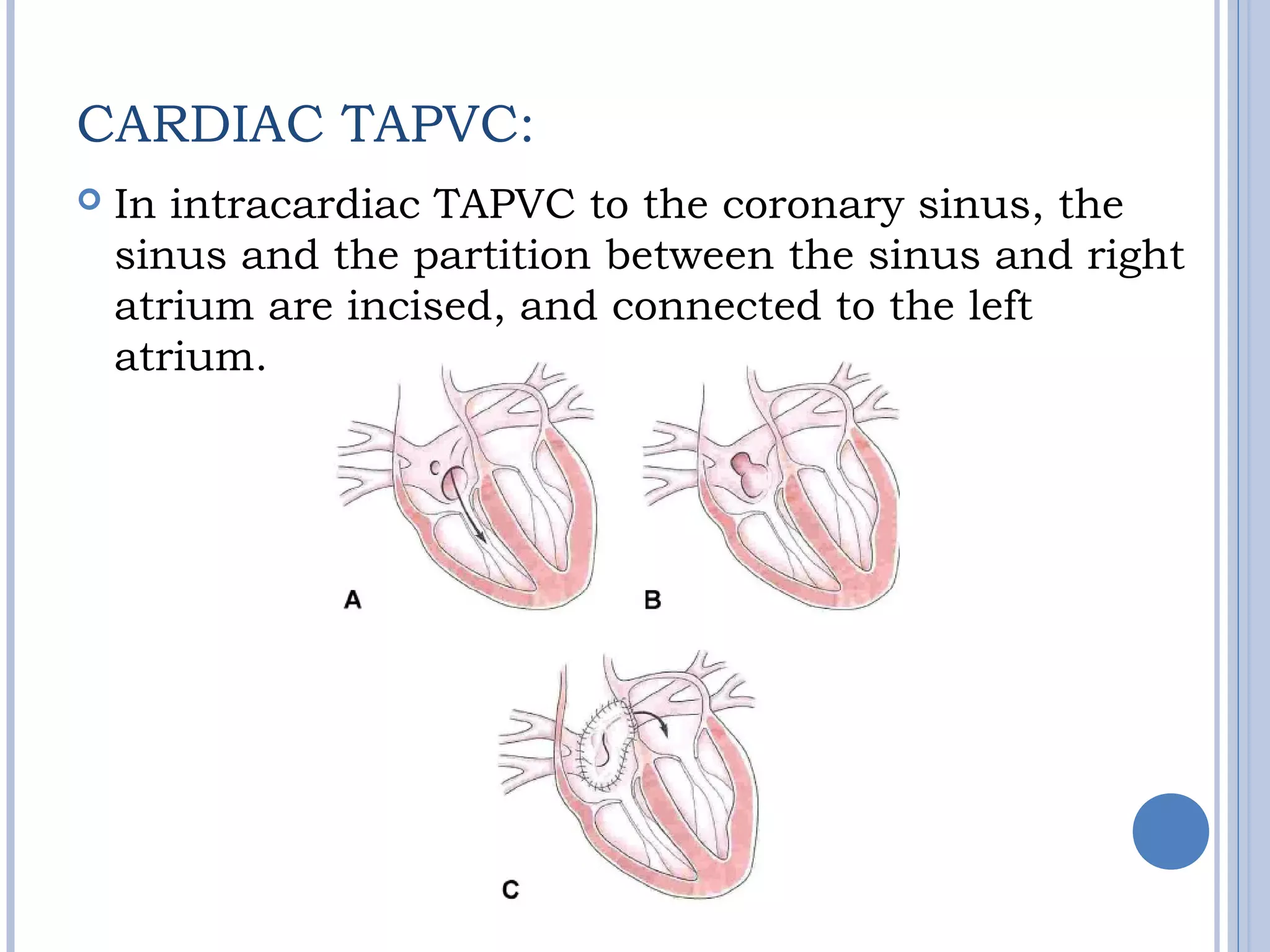 CARDIAC TAPVC:
 In intracardiac TAPVC to the coronary sinus, the
sinus and the partition between the sinus and right
atrium are incised, and connected to the left
atrium.
 