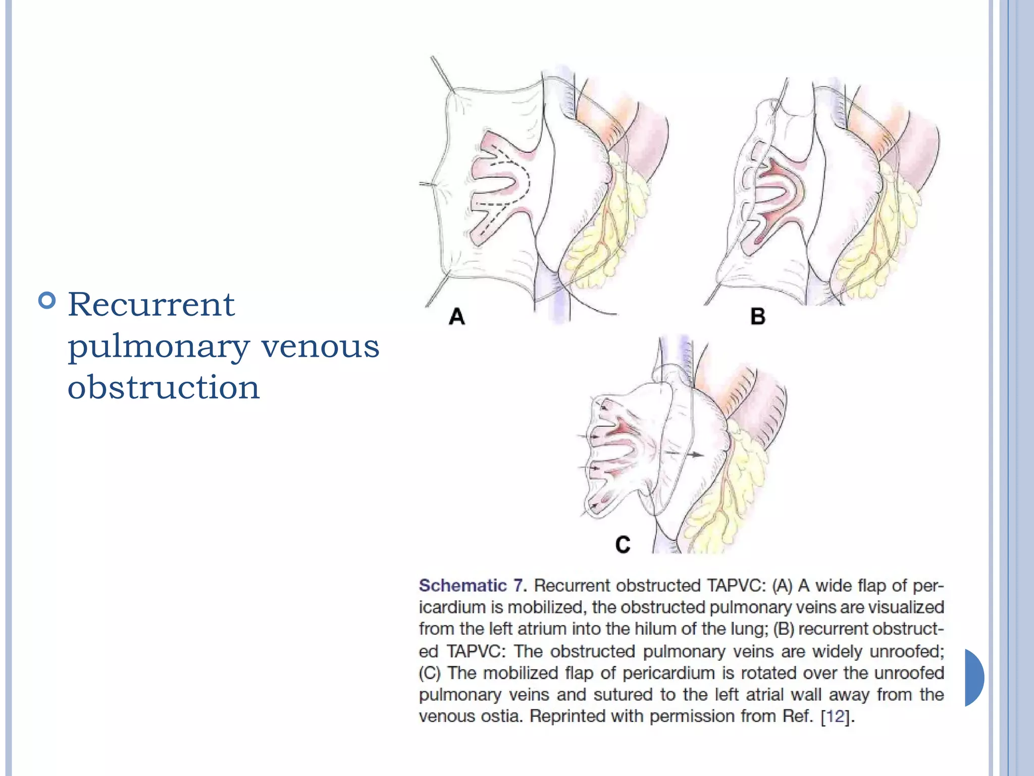  Recurrent
pulmonary venous
obstruction
 