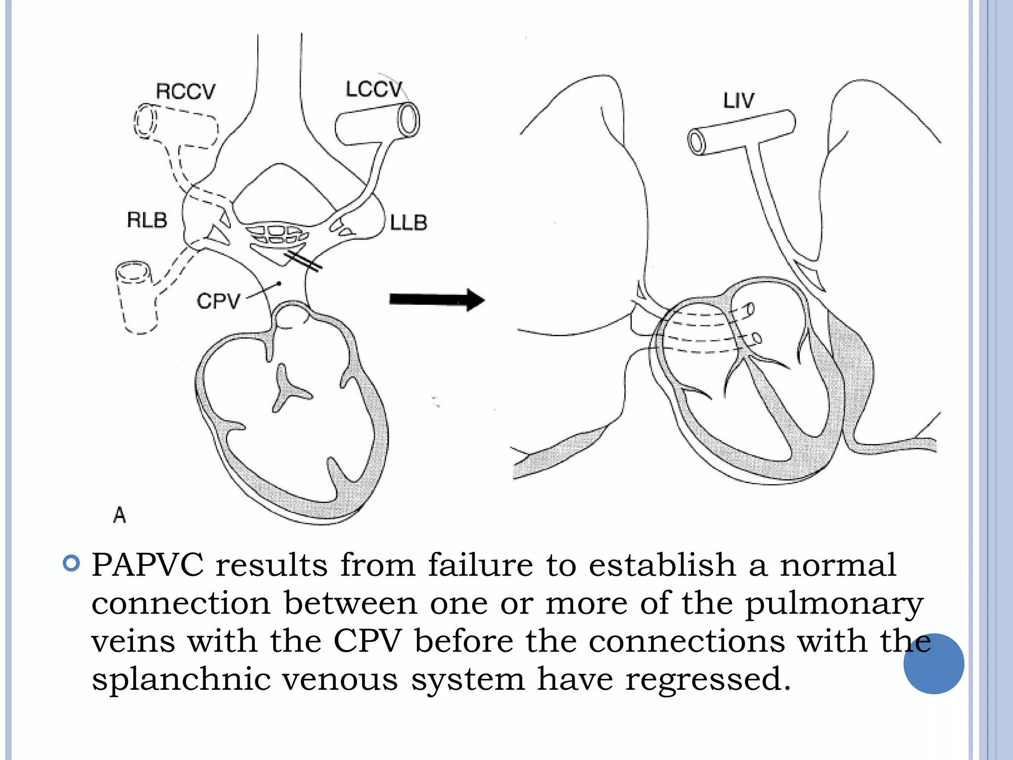  PAPVC results from failure to establish a normal
connection between one or more of the pulmonary
veins with the CPV before the connections with the
splanchnic venous system have regressed.
 