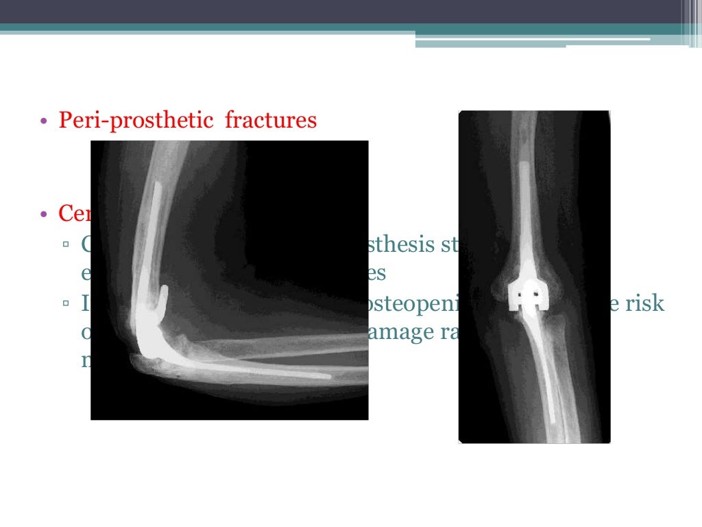 Total elbow arthroplasty