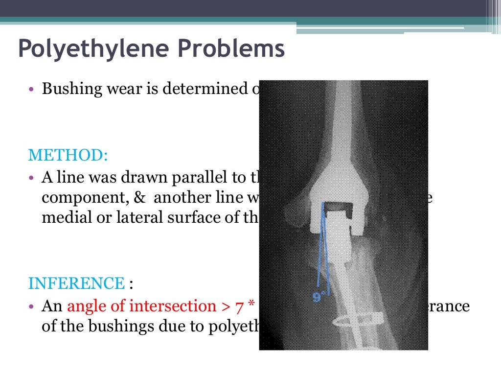 Total elbow arthroplasty