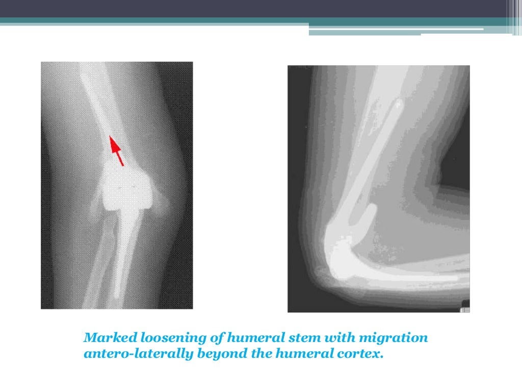 Total elbow arthroplasty