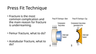Underreaming Chart total hip fixation 111111111111111111111 | PPTX