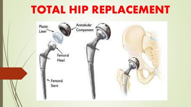 Hip replacement size prothesis