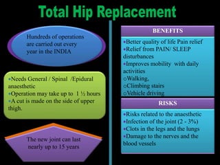 Hundreds of operations
are carried out every
year in the INDIA
Needs General / Spinal /Epidural
anaesthetic
Operation may take up to 1 ½ hours
A cut is made on the side of upper
thigh.
The new joint can last
nearly up to 15 years
BENEFITS
Better quality of life Pain relief
Relief from PAIN/ SLEEP
disturbances
Improves mobility with daily
activities
oWalking,
oClimbing stairs
oVehicle driving
RISKS
Risks related to the anaesthetic
Infection of the joint (2 - 3%)
Clots in the legs and the lungs
Damage to the nerves and the
blood vessels
 