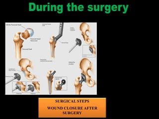 SURGICAL STEPS
WOUND CLOSURE AFTER
SURGERY
 