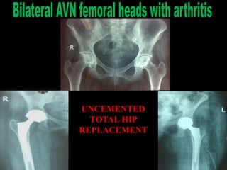 UNCEMENTED
TOTAL HIP
REPLACEMENT
 