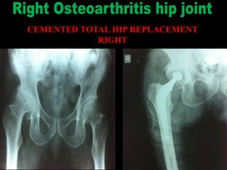 CEMENTED TOTAL HIP REPLACEMENT
RIGHT
 