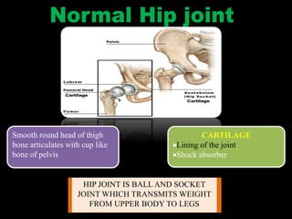 Smooth round head of thigh
bone articulates with cup like
bone of pelvis
CARTILAGE
Lining of the joint
Shock absorber
HIP JOINT IS BALL AND SOCKET
JOINT WHICH TRANSMITS WEIGHT
FROM UPPER BODY TO LEGS
 